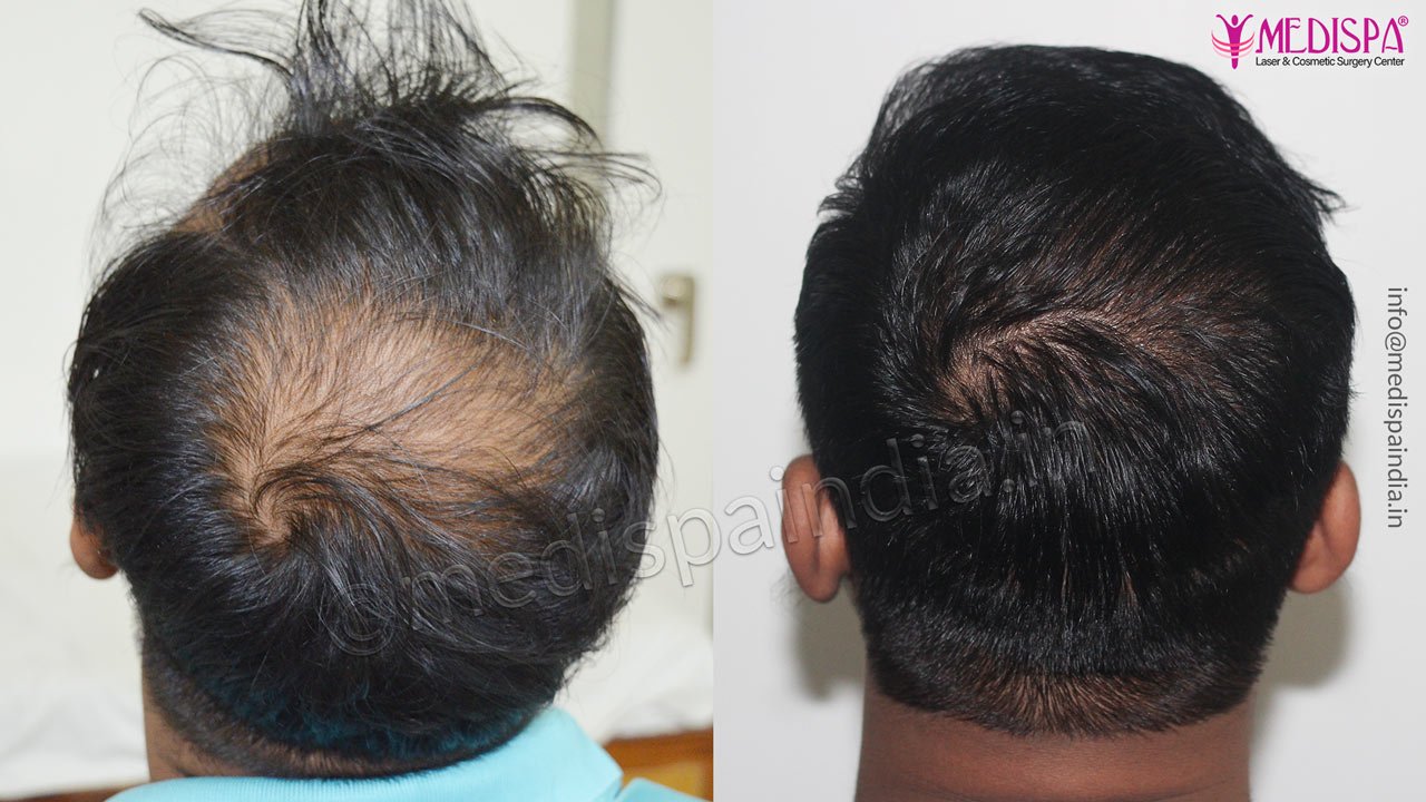 Hair Transplant Delhi after before