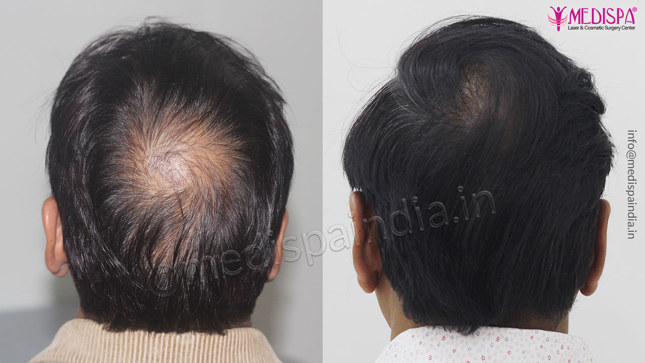 Hair Transplant India after before
