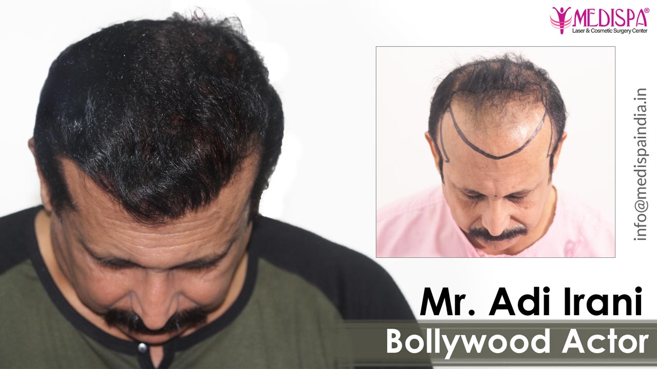 actor-adi-irani-hair-transplant