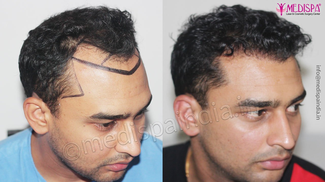 after before hair transplant results