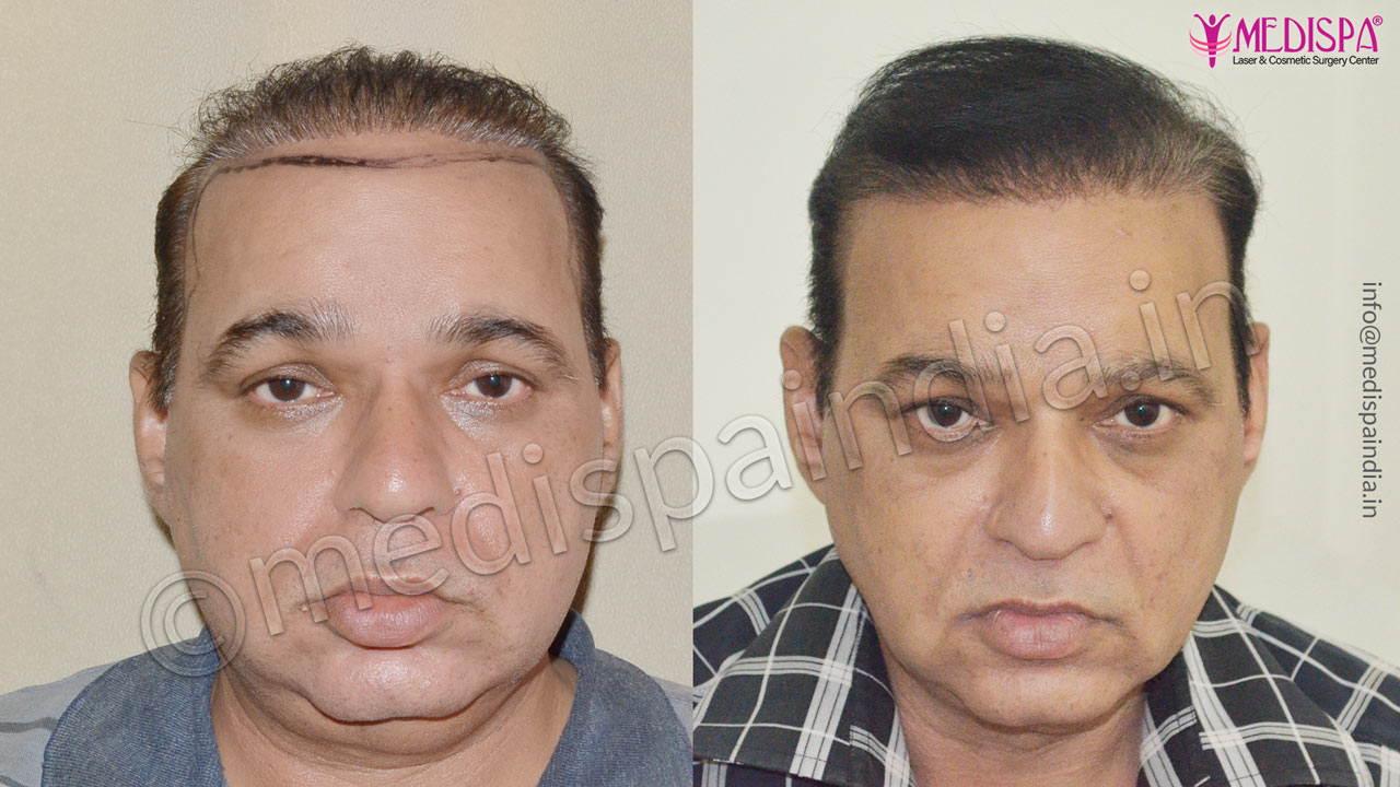 bad hair transplant repair india