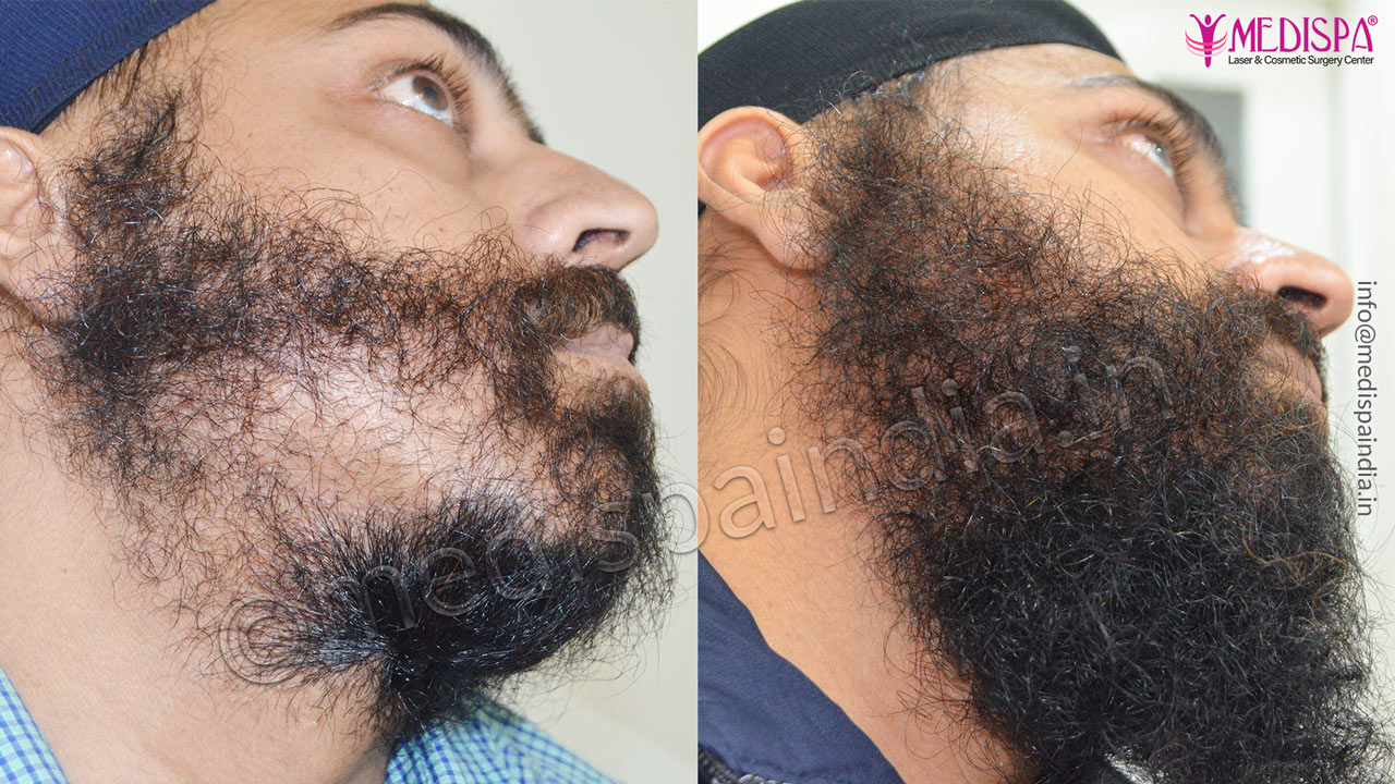 beard hair transplant india