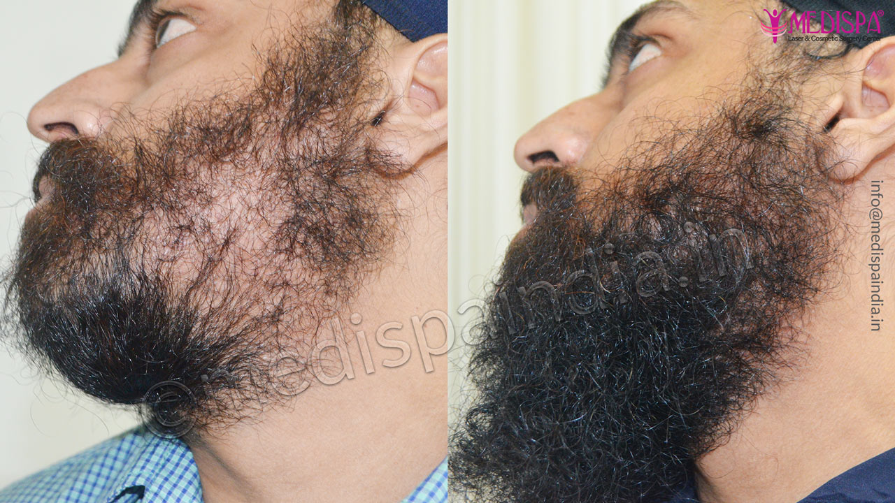 beard hair transplant result india
