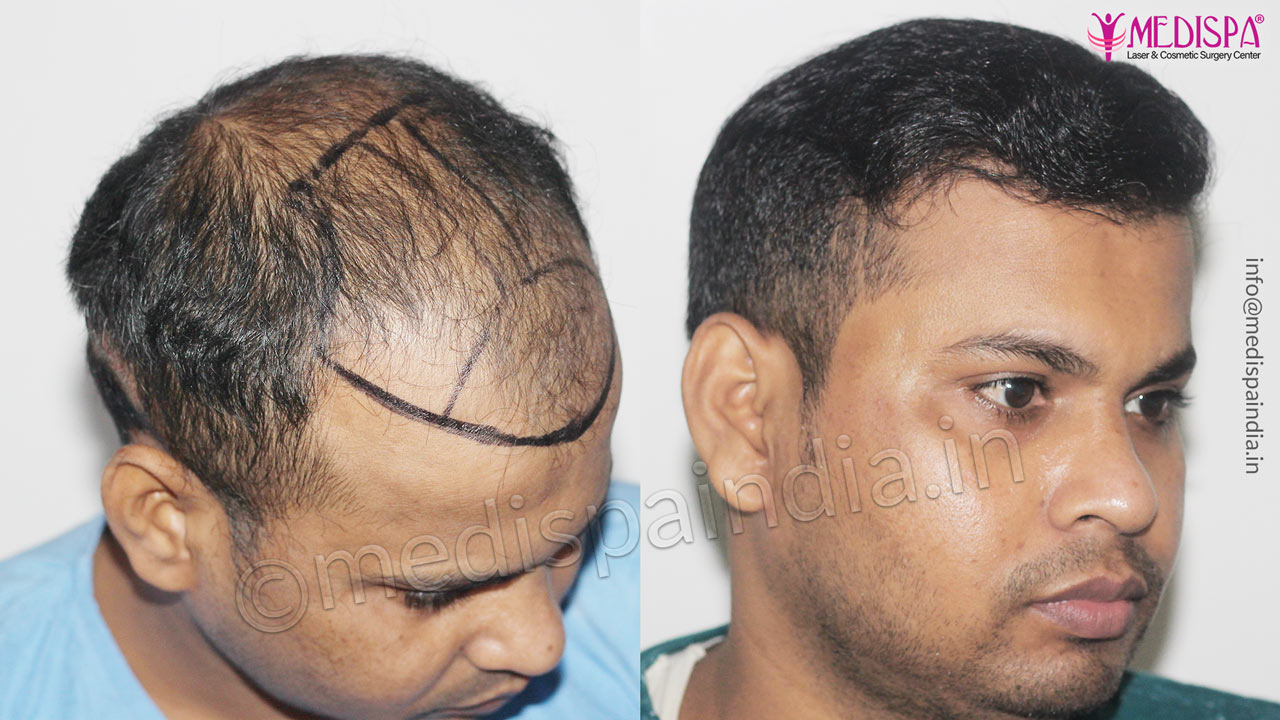 best hair restoration results delhi