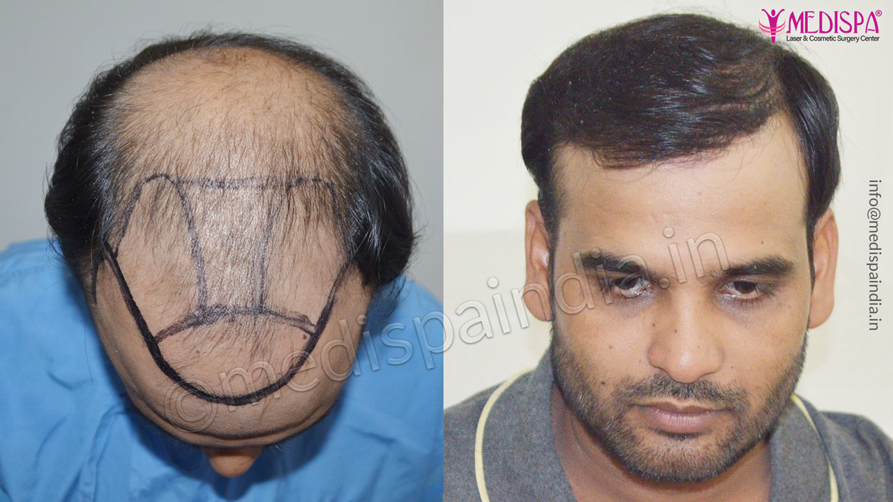 FUT Hair Transplant Results in Ahmedabad | Medispa India FUT Hair Transplant Results in Ahmedabad | Medispa India