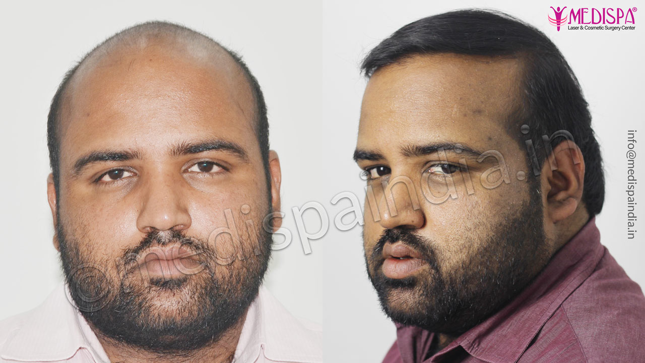best hair transplant clinics in gurgaon