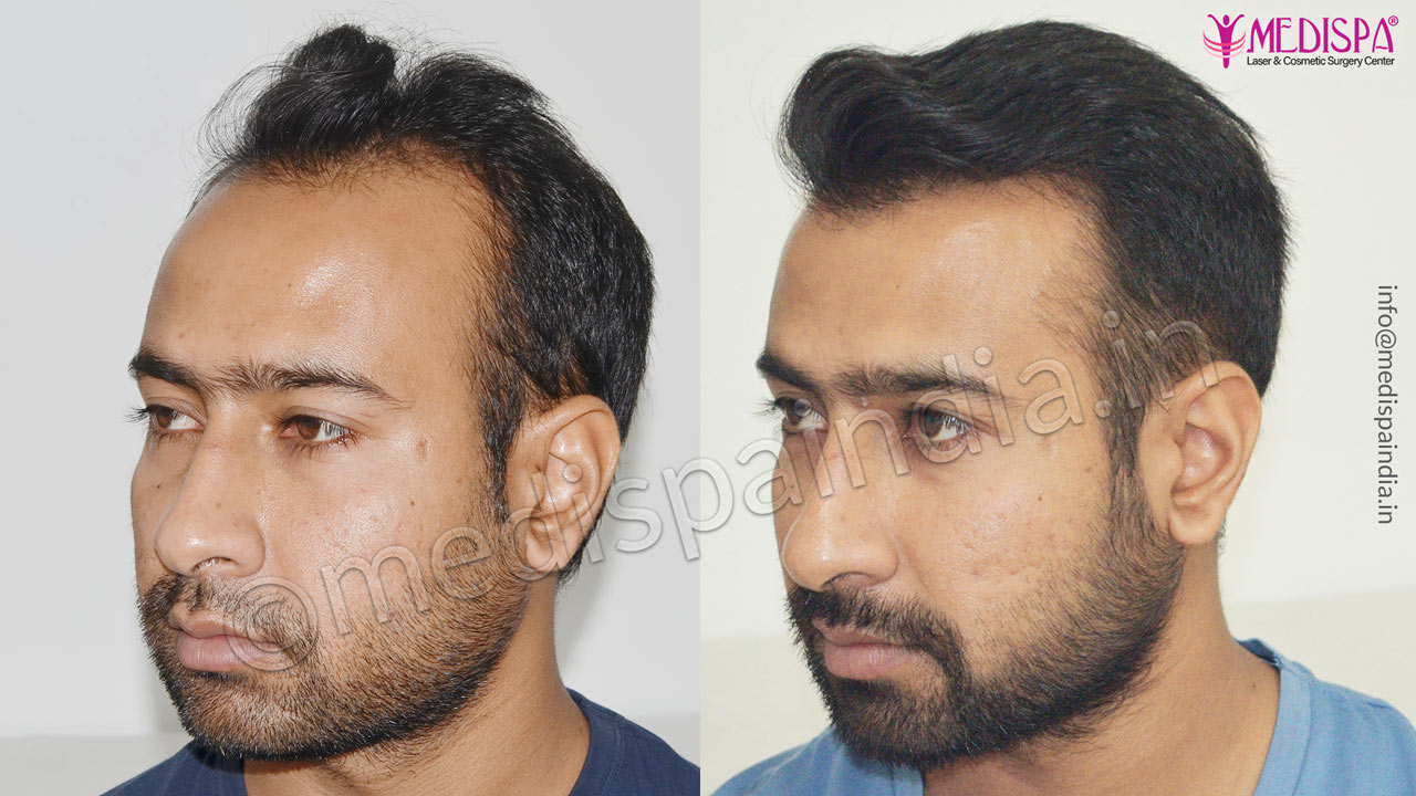 best hair transplant clinics in hyderabad