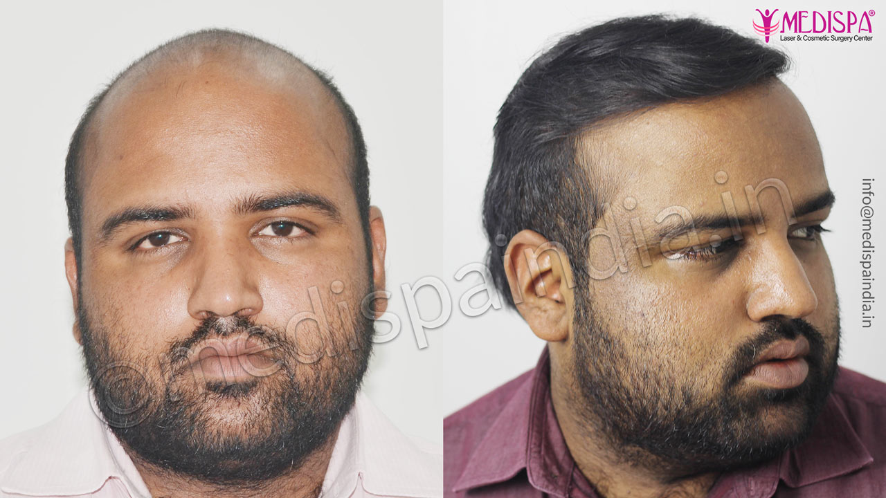 best hair transplant doctors in gurgaon