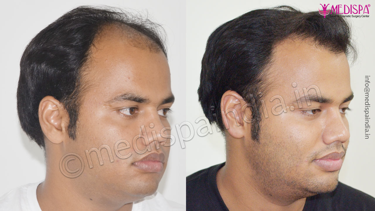 best hair transplant rajasthan