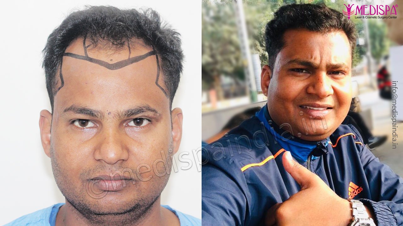 best hair transplant rajathan after