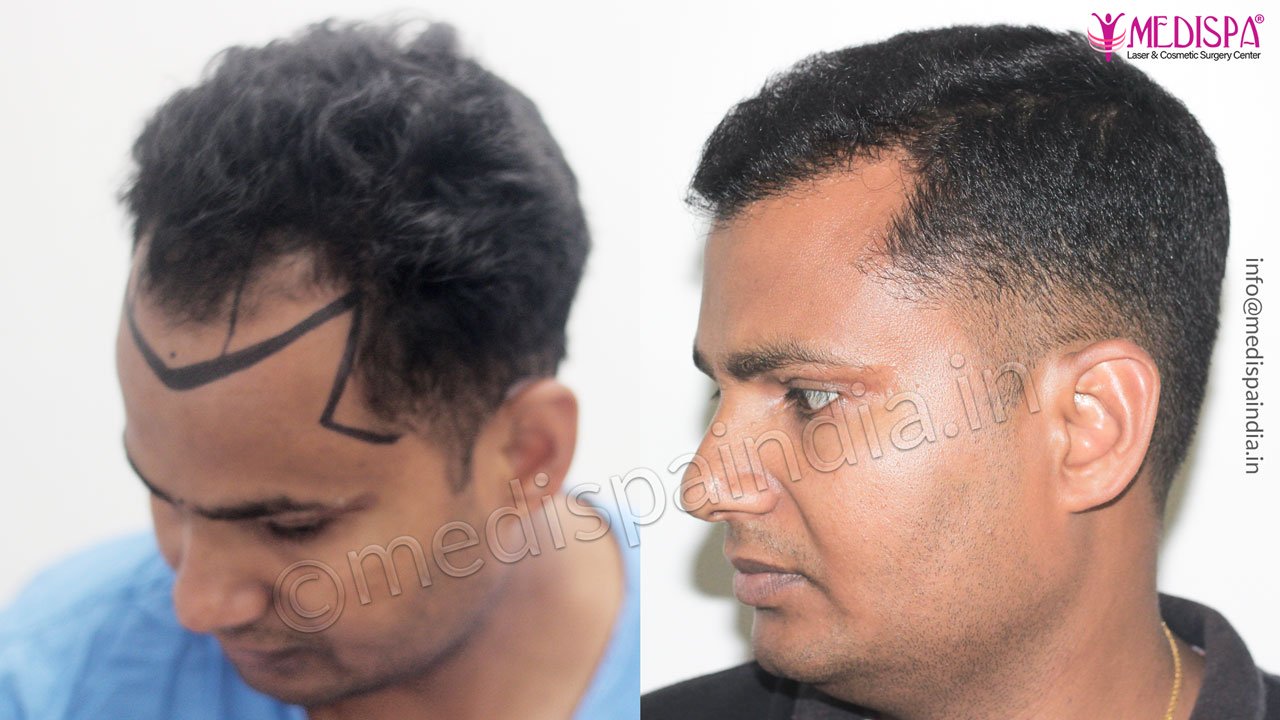 best hair transplant rajathan results