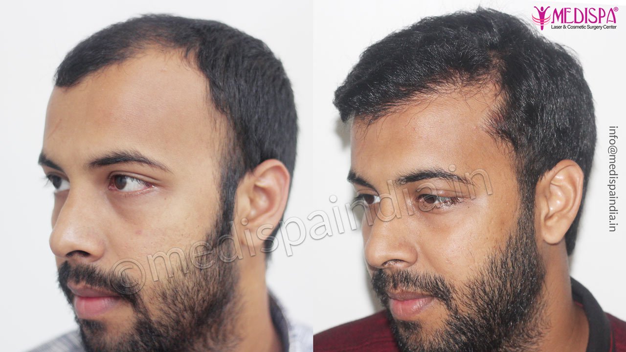 best hair transplant results delhi