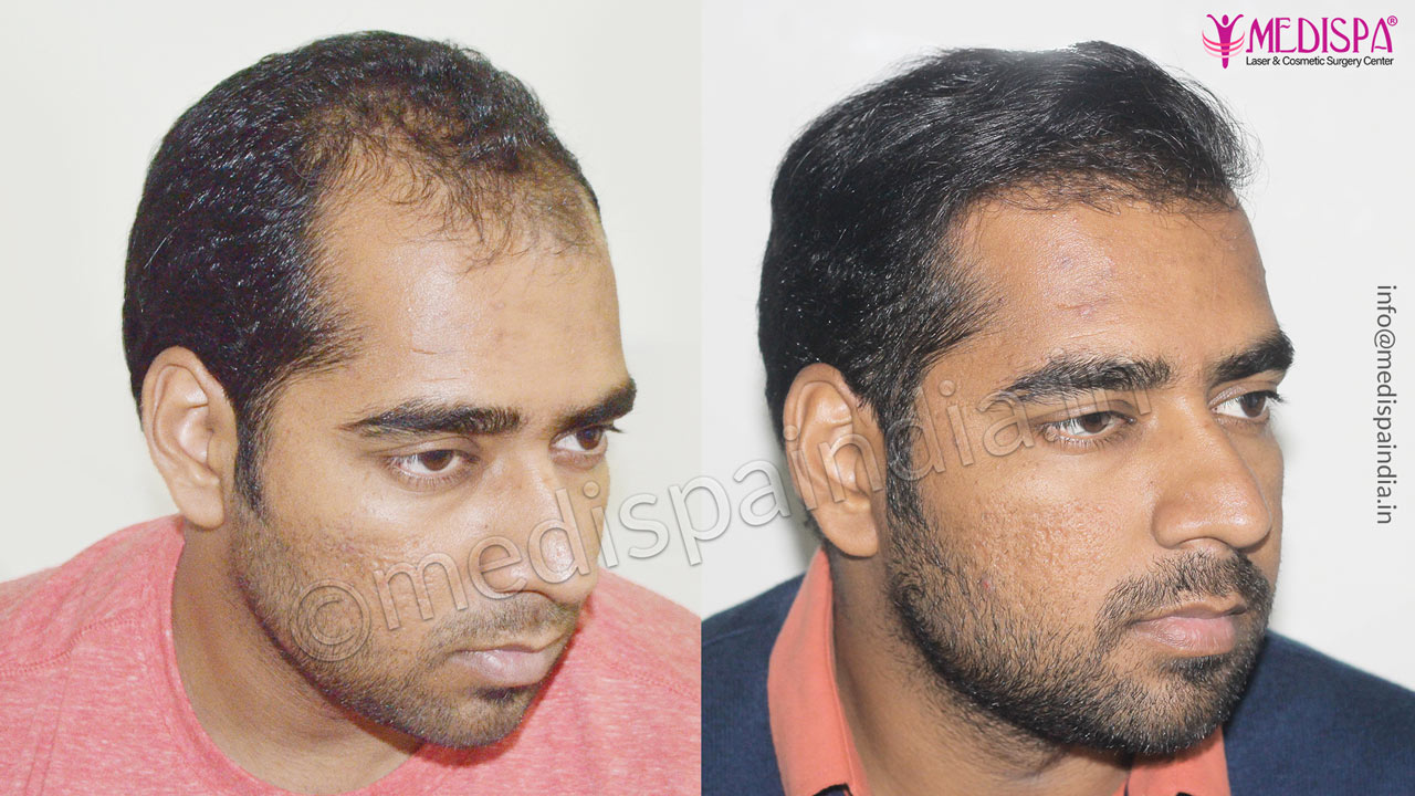 best hair transplant results in india