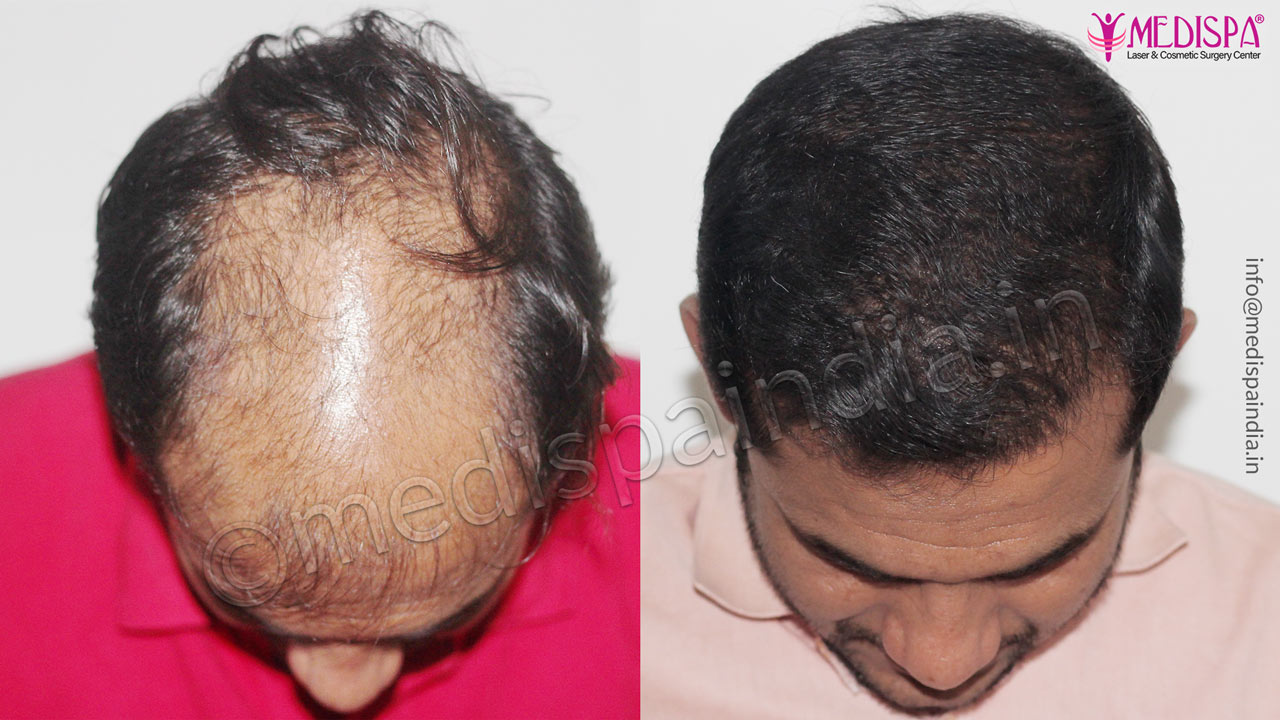 best hair transplant results Hyderabad