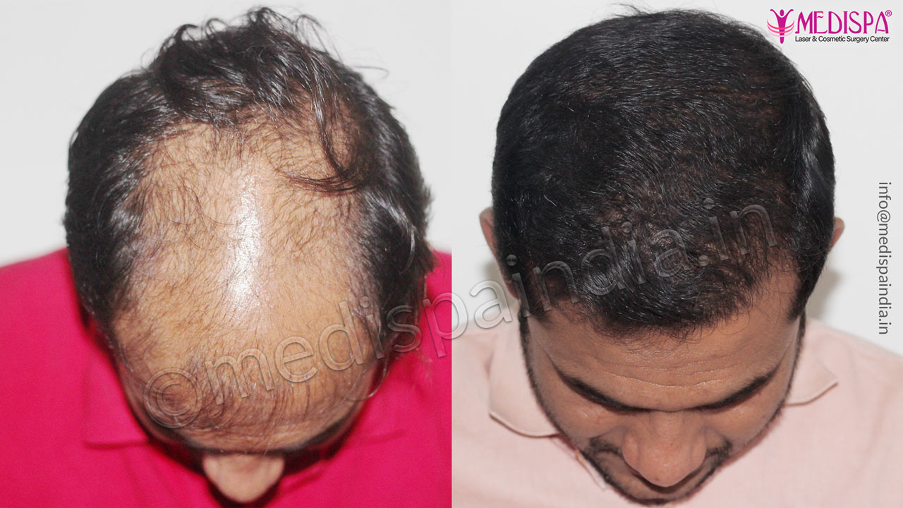 hair transplant cost in dubai