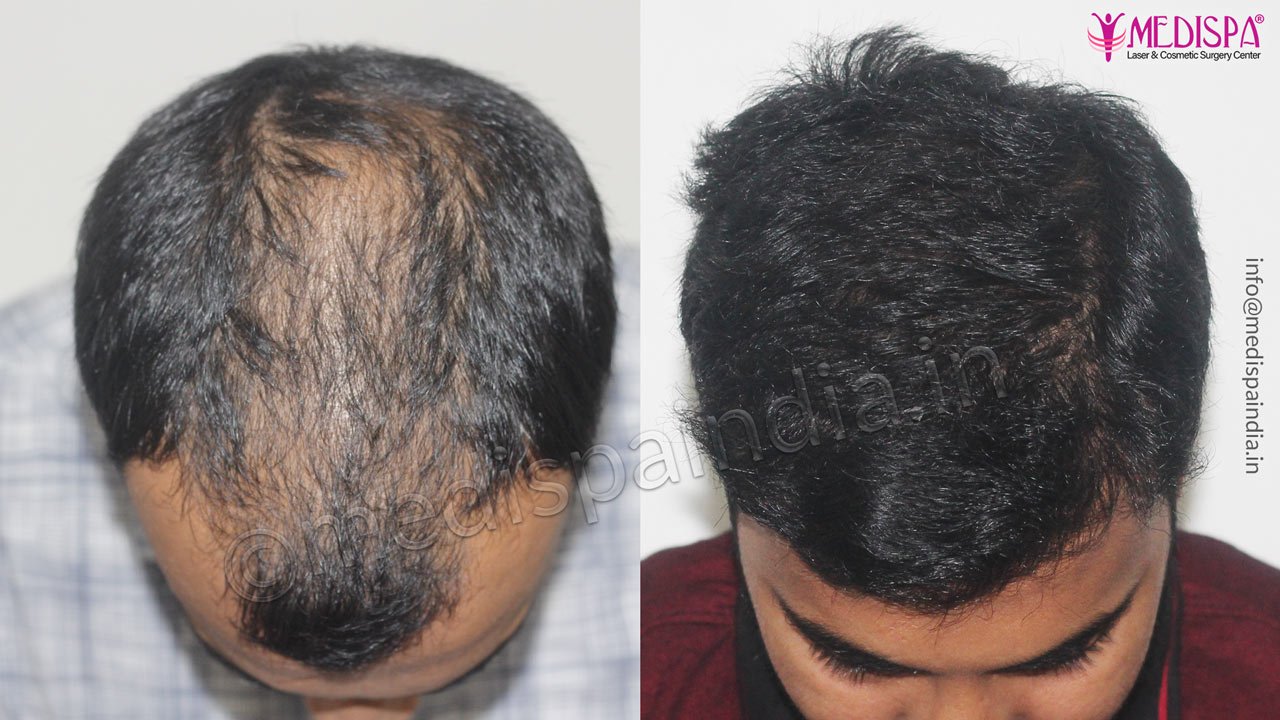 best hair transplant results delhi india