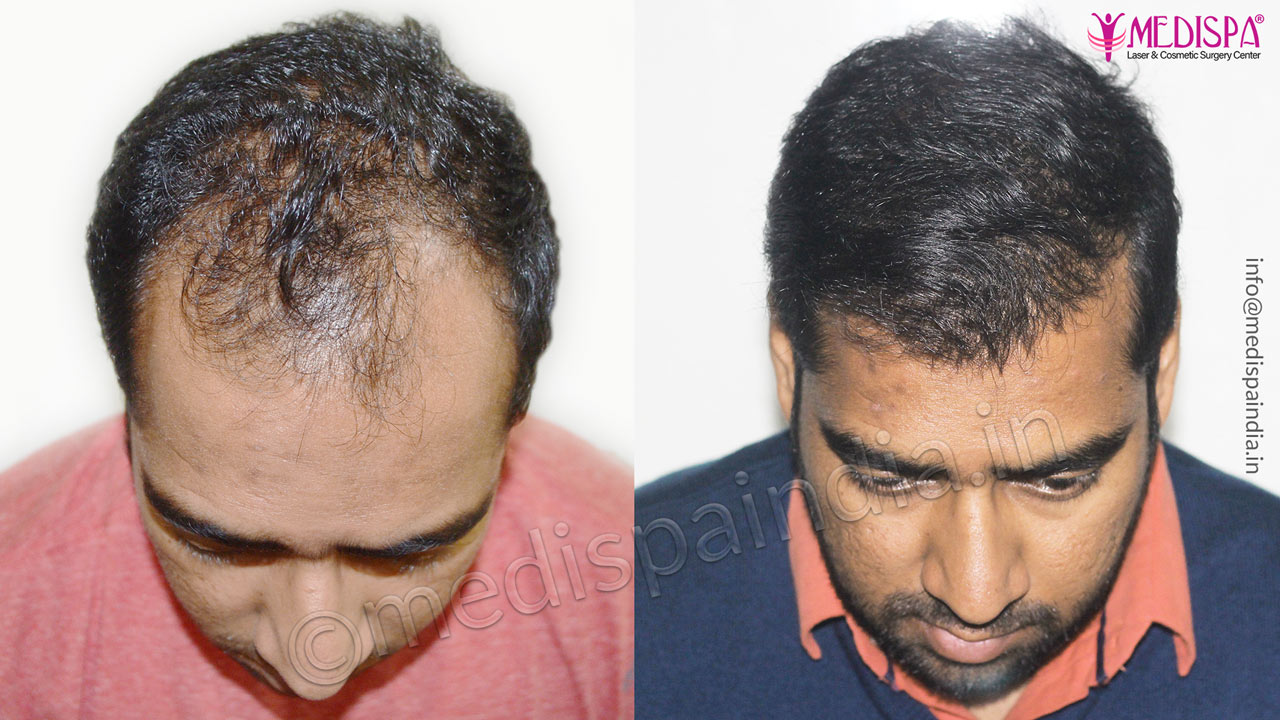 Male Hair Transplant Result After 10 Months | Medispa India Male Hair Transplant Result After 10 Months | Medispa India