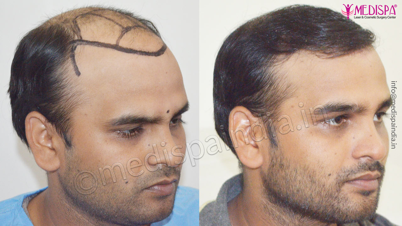 Hair Transplant Cost in Surat, Gujarat, india