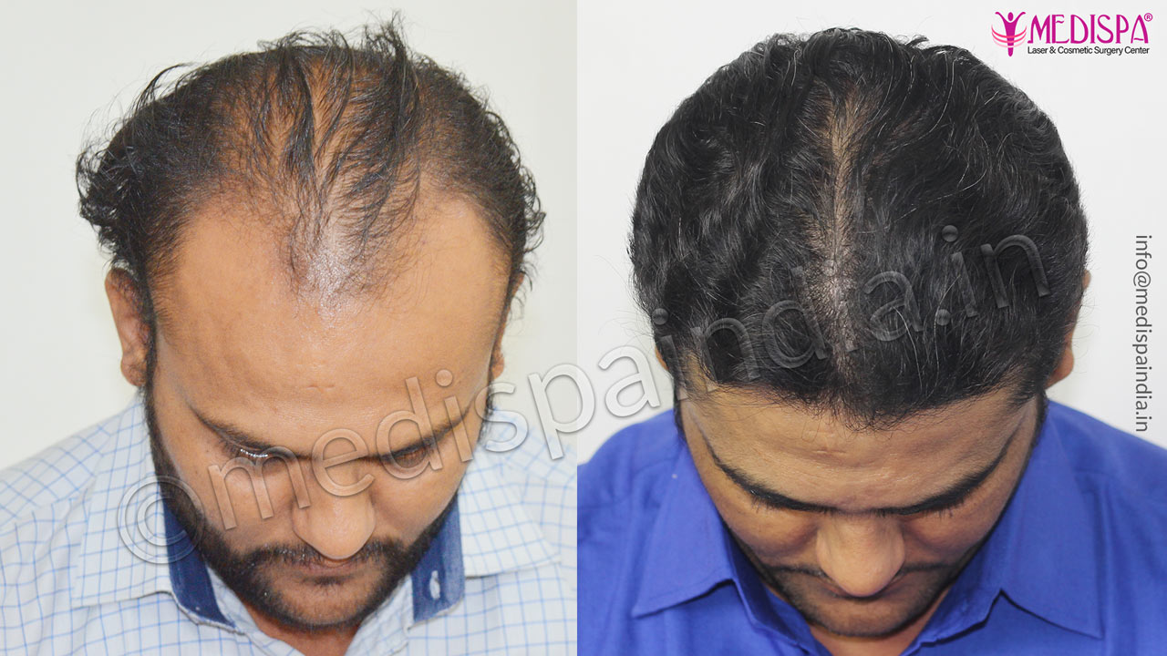 best hair transplant surgeons in bangladesh