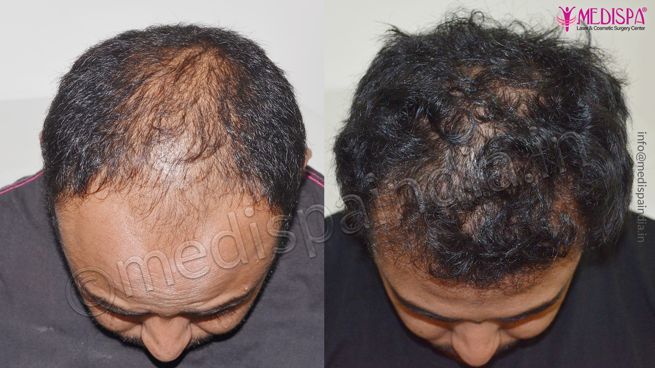 best hair transplant surgeons in dehradun