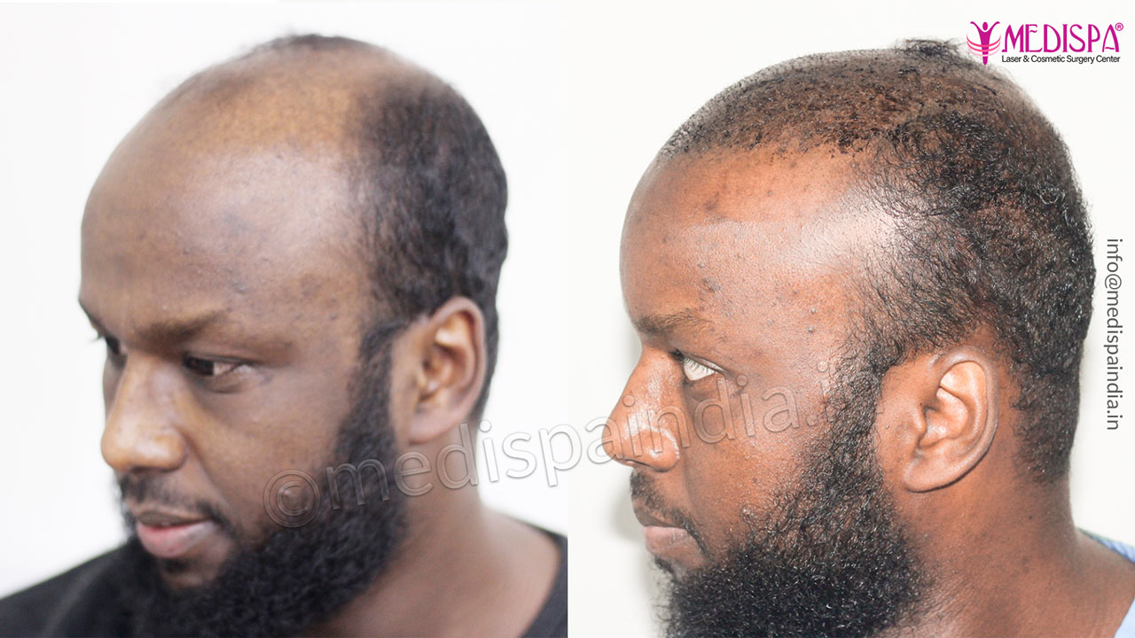 best hair transplant sweden results