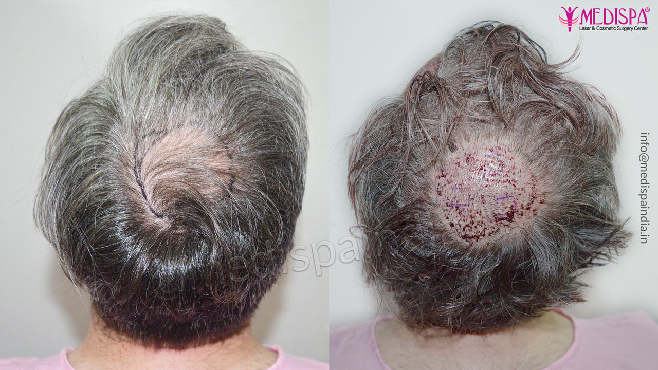best hair transplant uk results