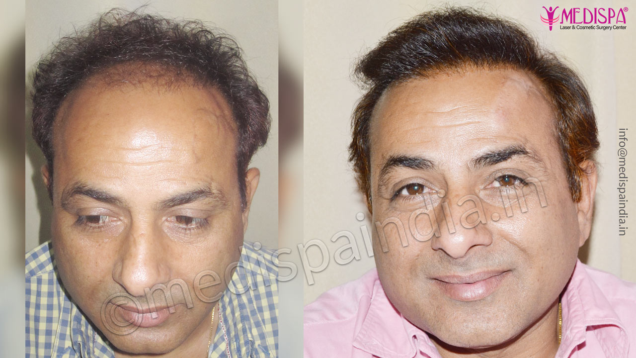 Wrong Hairline Correction, Medispa India Wrong Hairline Correction, Medispa India