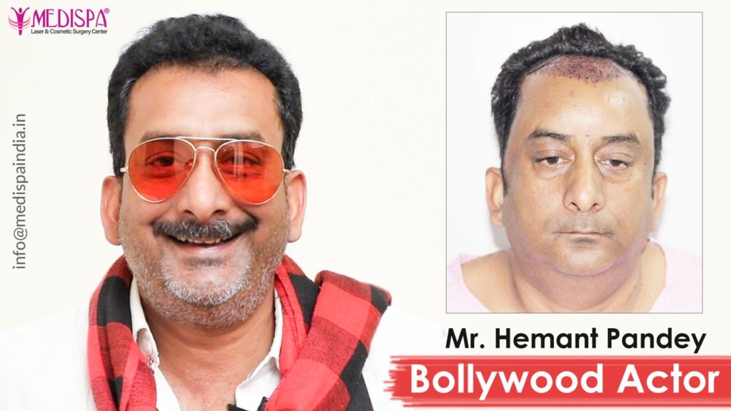 bollywood actor hemant pandey hair transplant