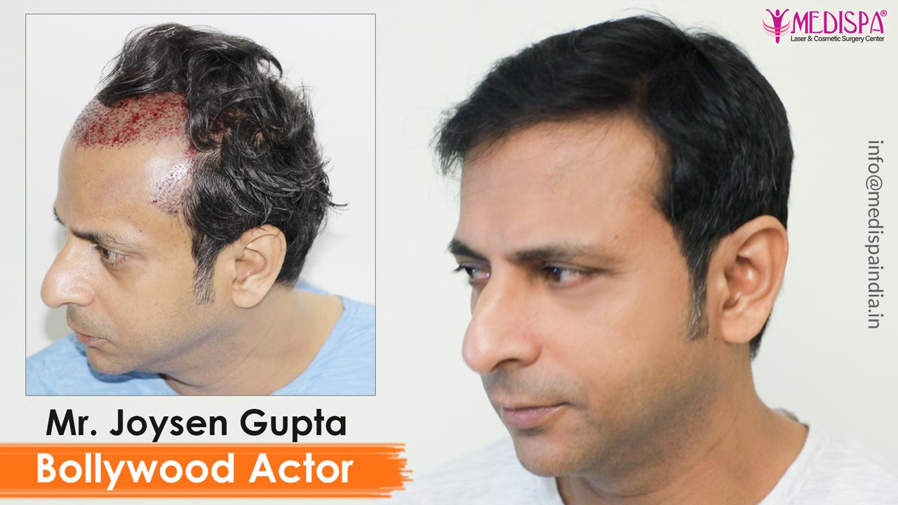 bollywood actor joysen gupta hair transplant india