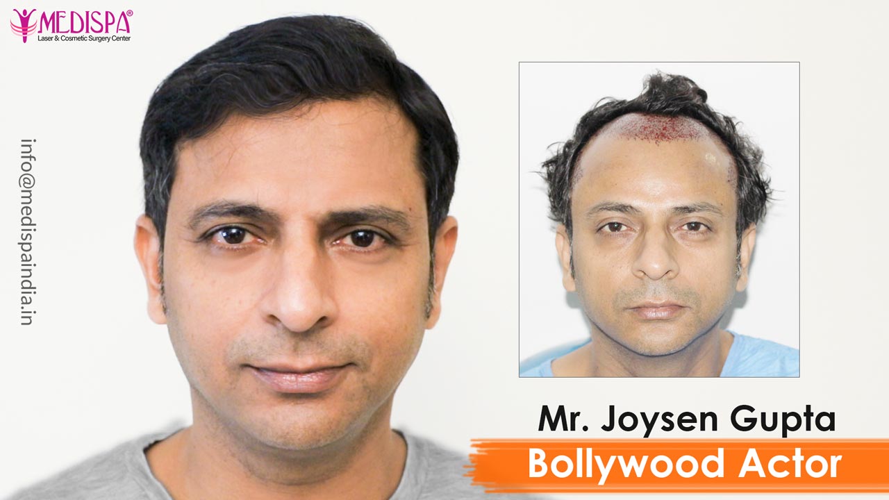 bollywood actor joysen gupta hair transplant