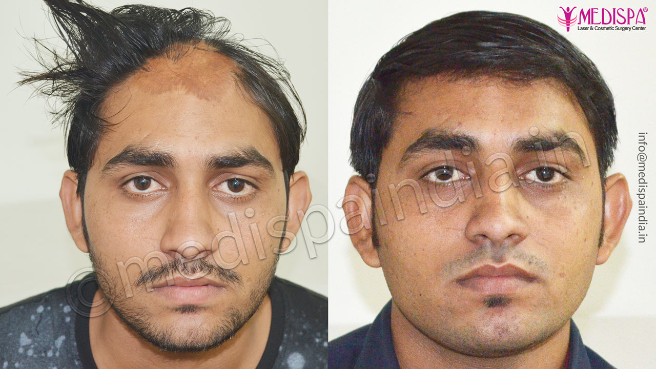 burn hair transplant correction delhi