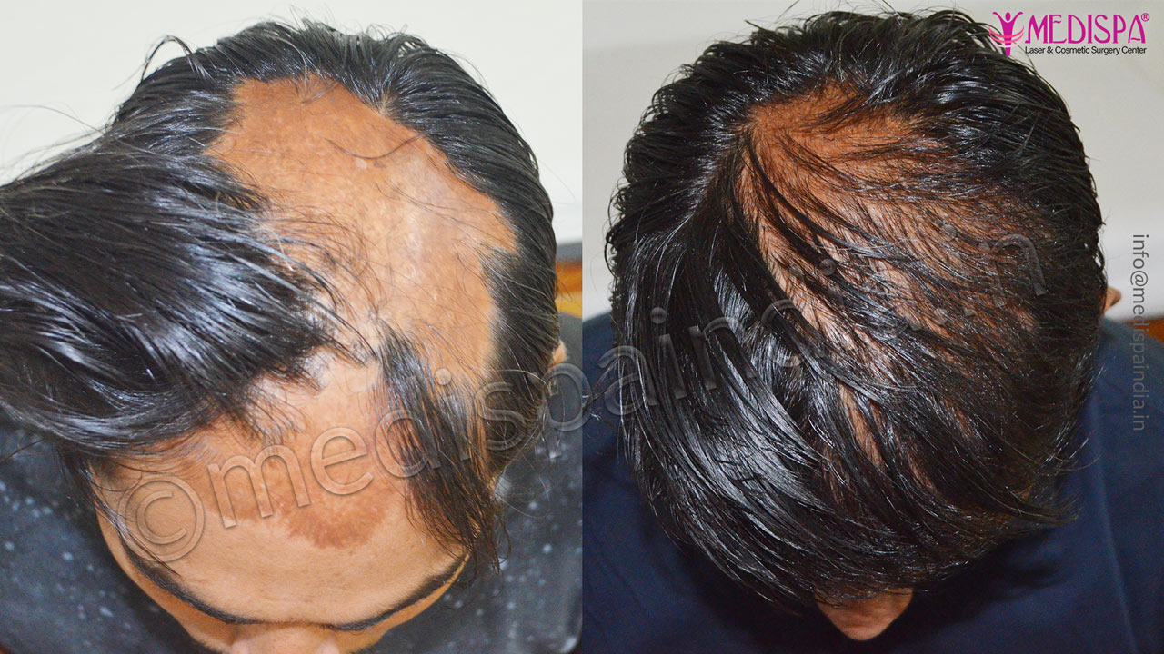 burn hair transplant jaipur