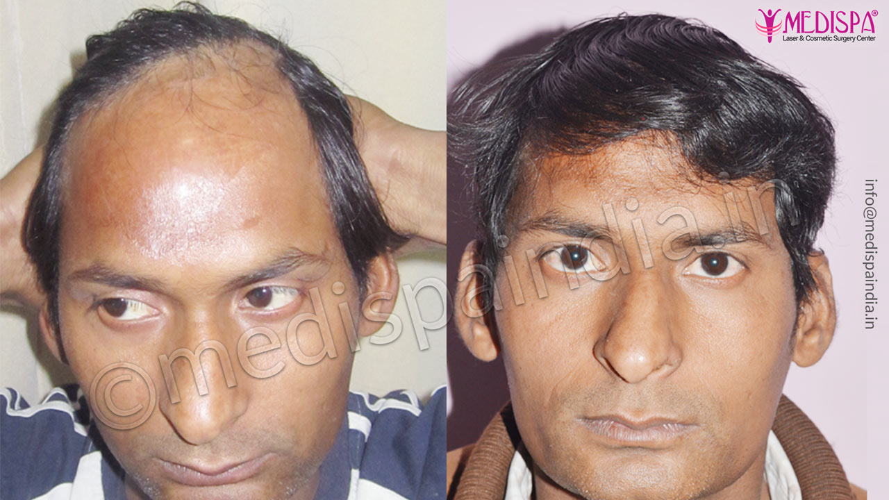 burn hair transplant repair rajasthan