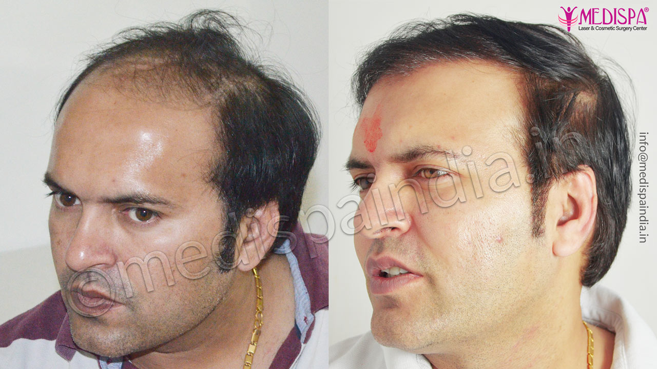 canada hair transplant cost