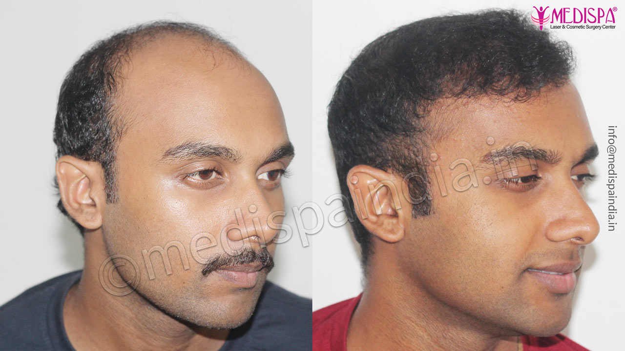 cost hair transplant india