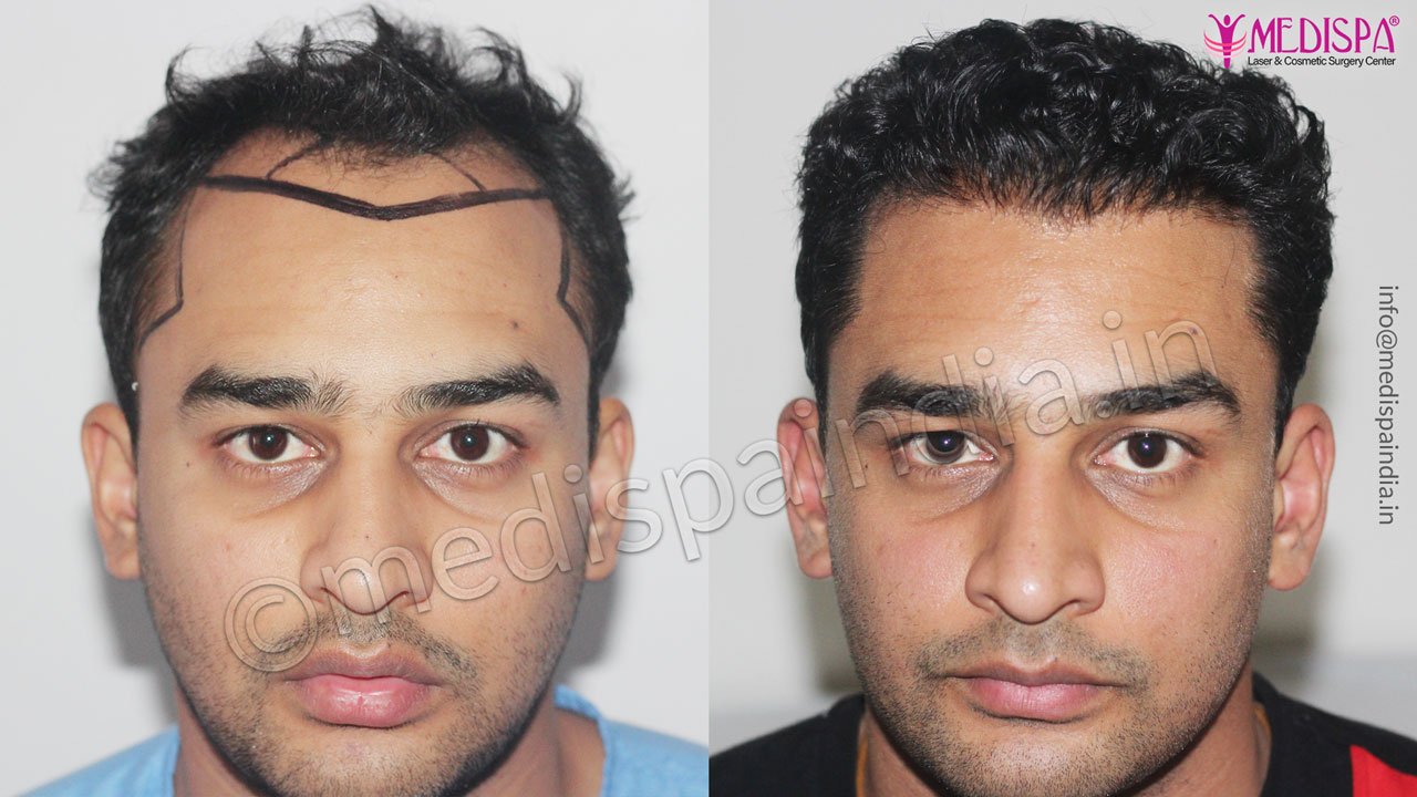 cost of hair transplant results
