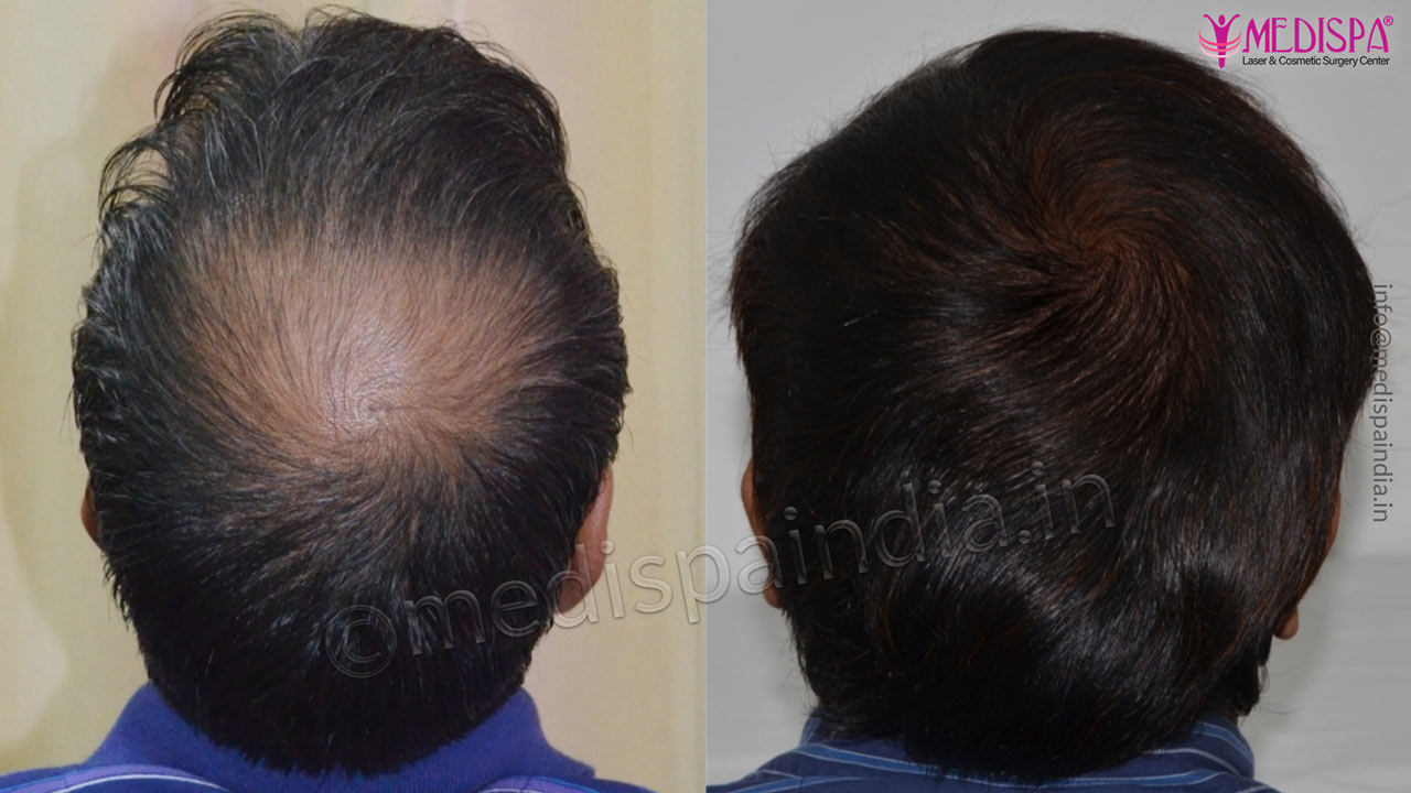 crown hair transplant india