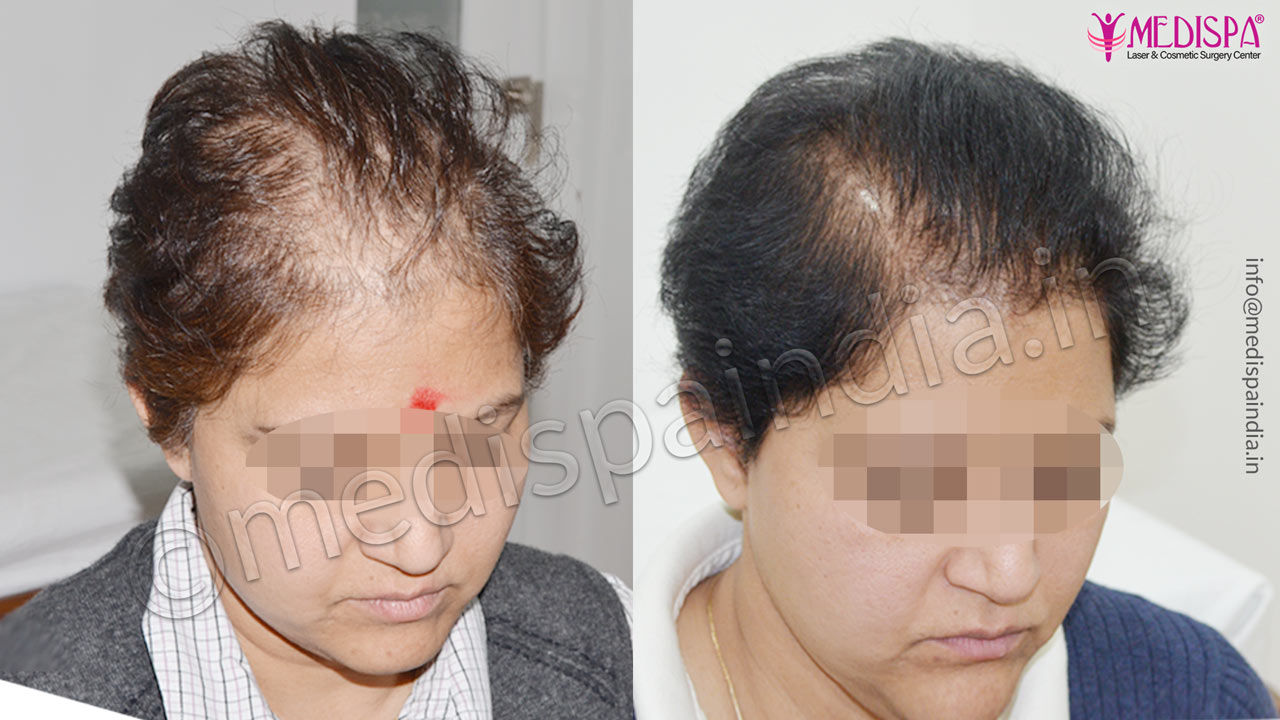 female hair transplant cost jaipur