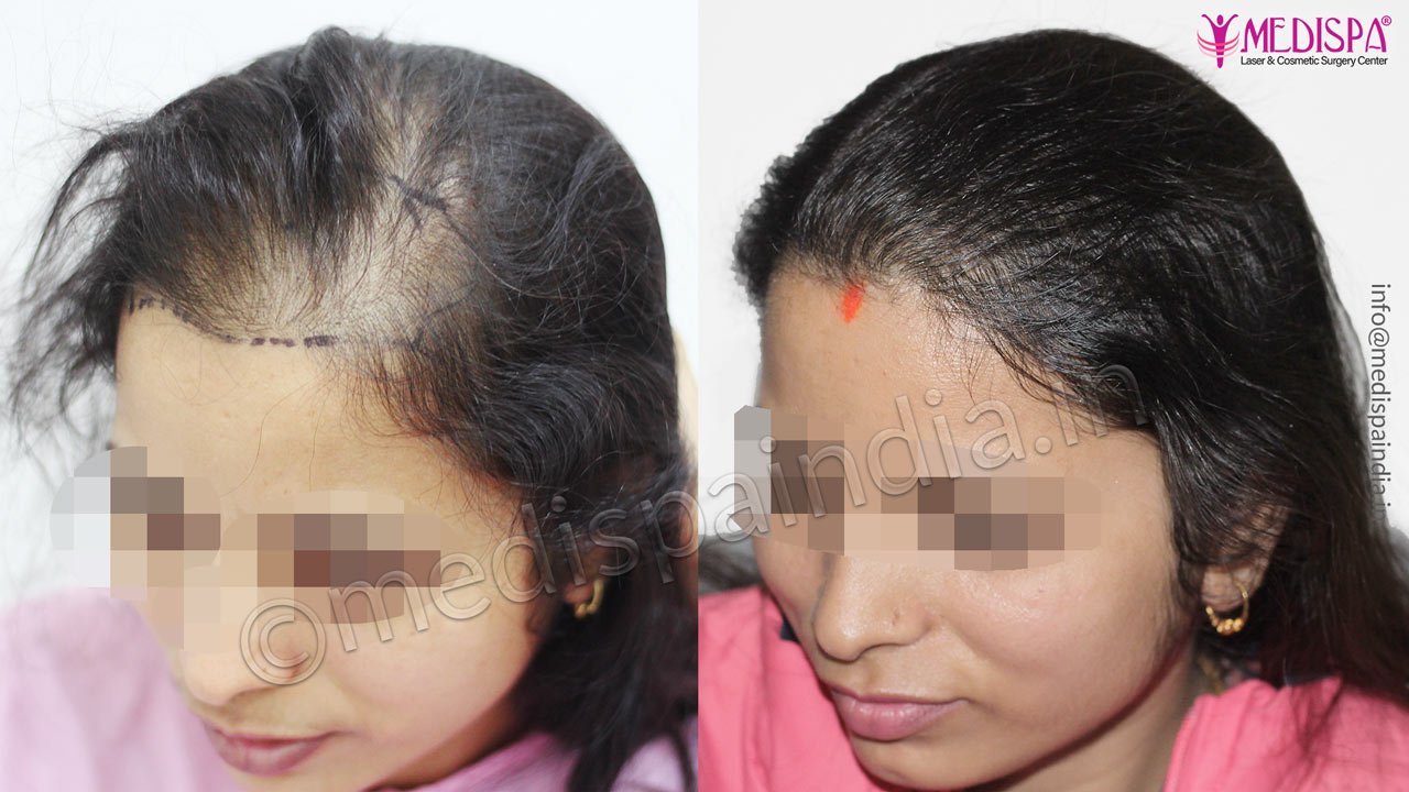 female hair transplant in delhi