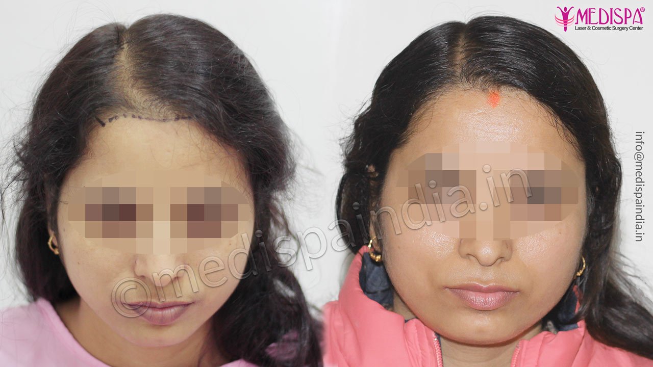 female hair transplant jaipur