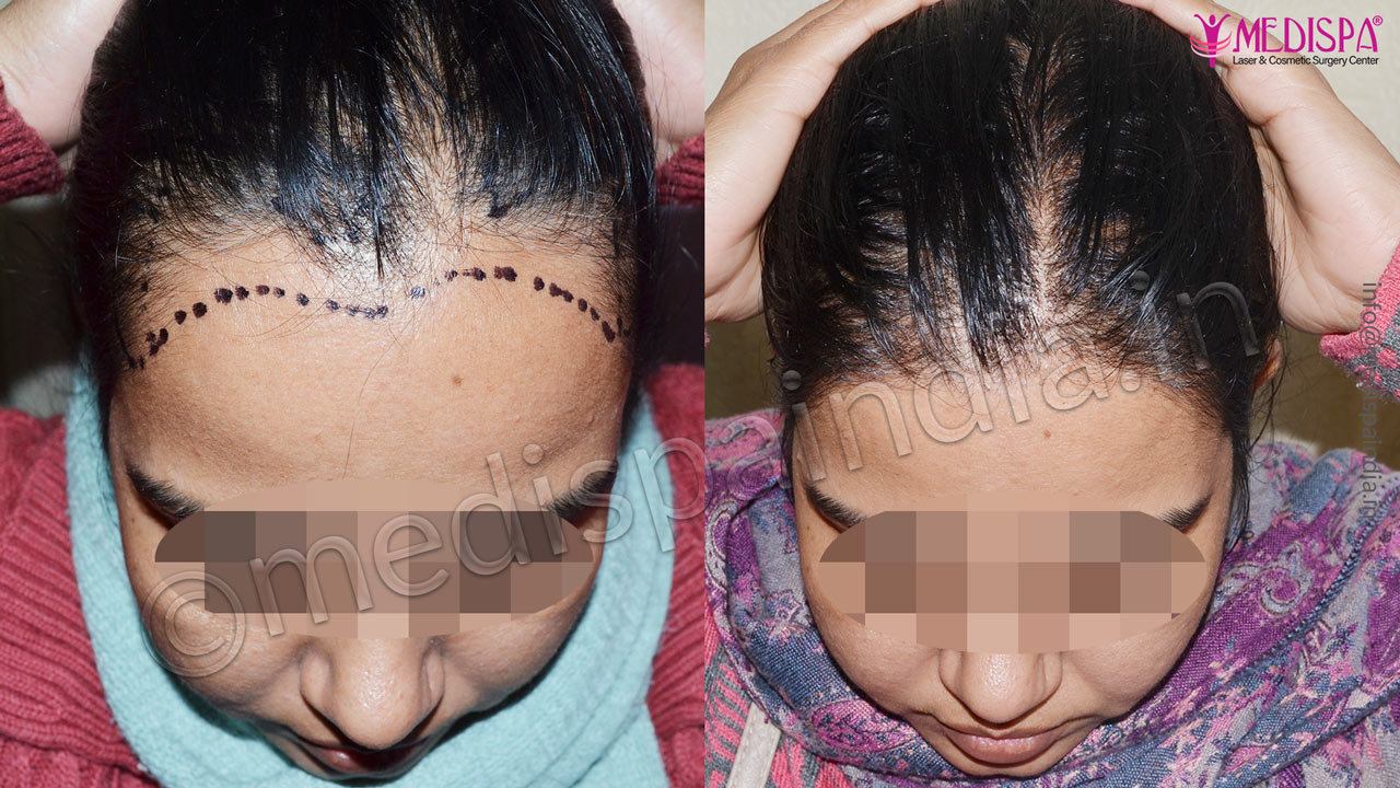 female hair transplant results delhi india
