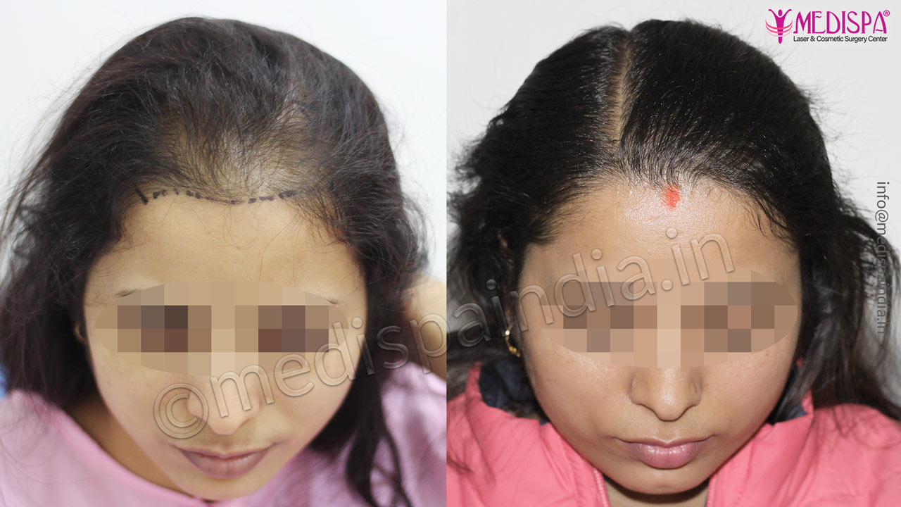 female hair transplant results delhi