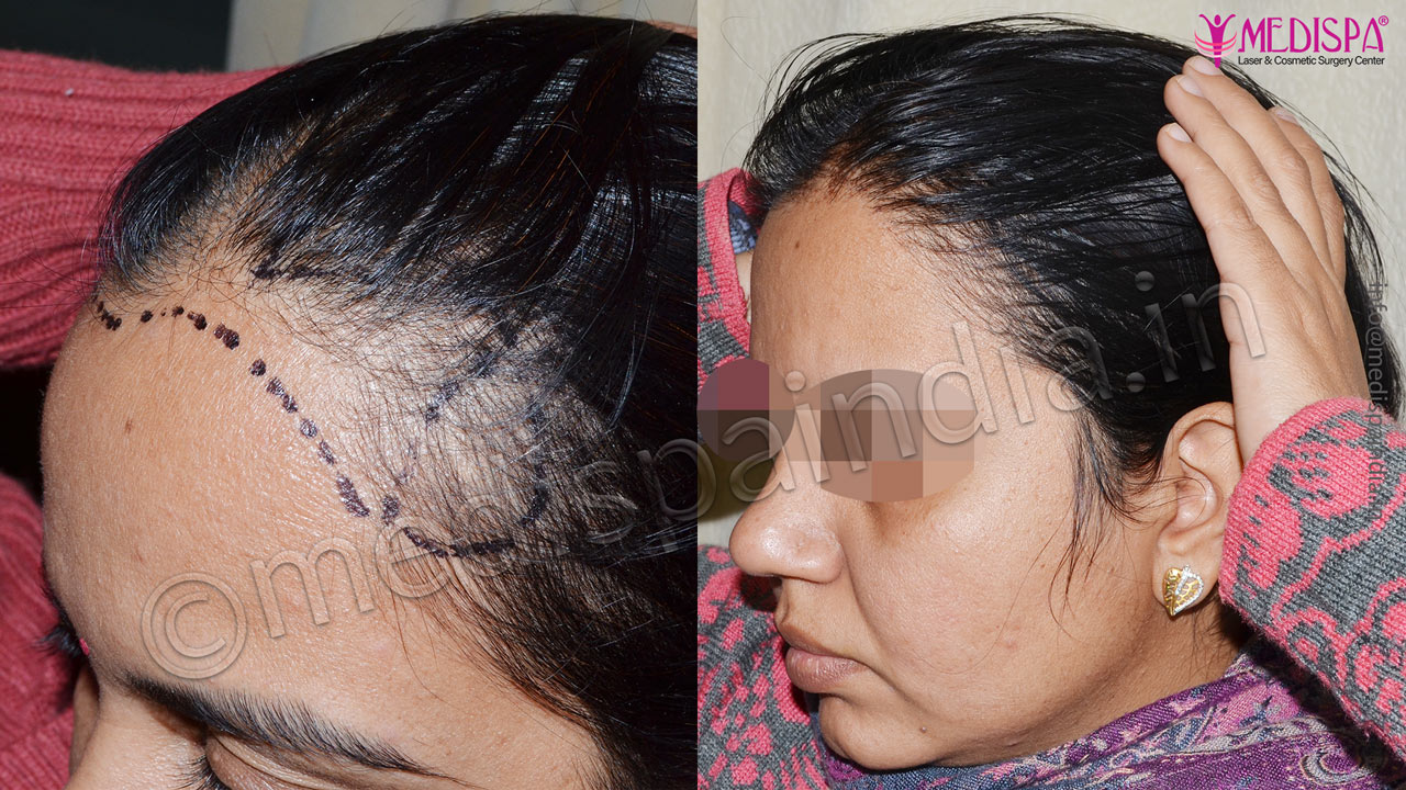 female hair transplant results jaipur