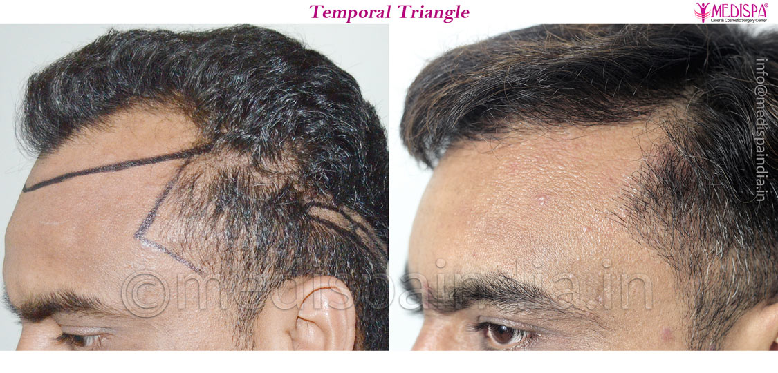 fue hair transplant australia