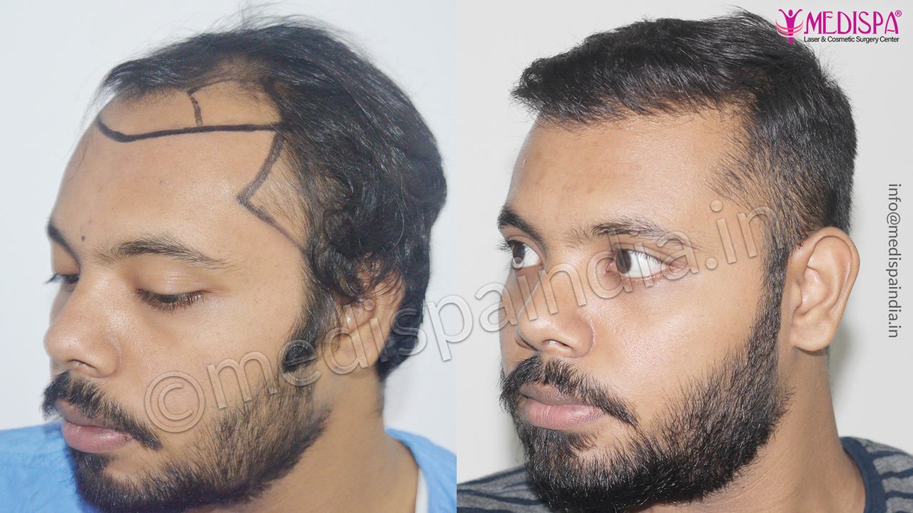 fue hair transplant before after