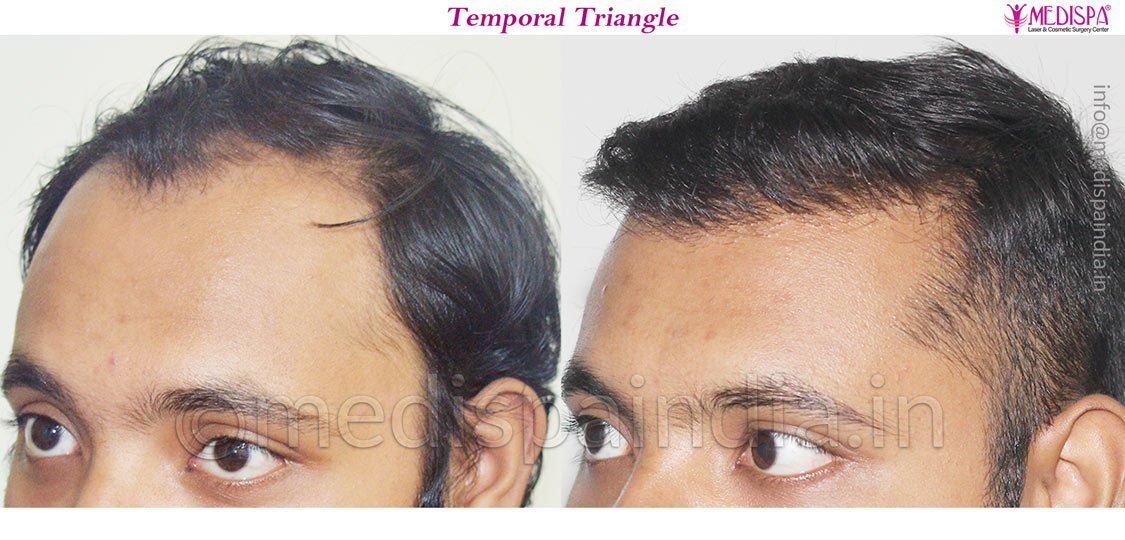 fue hair transplant cost india