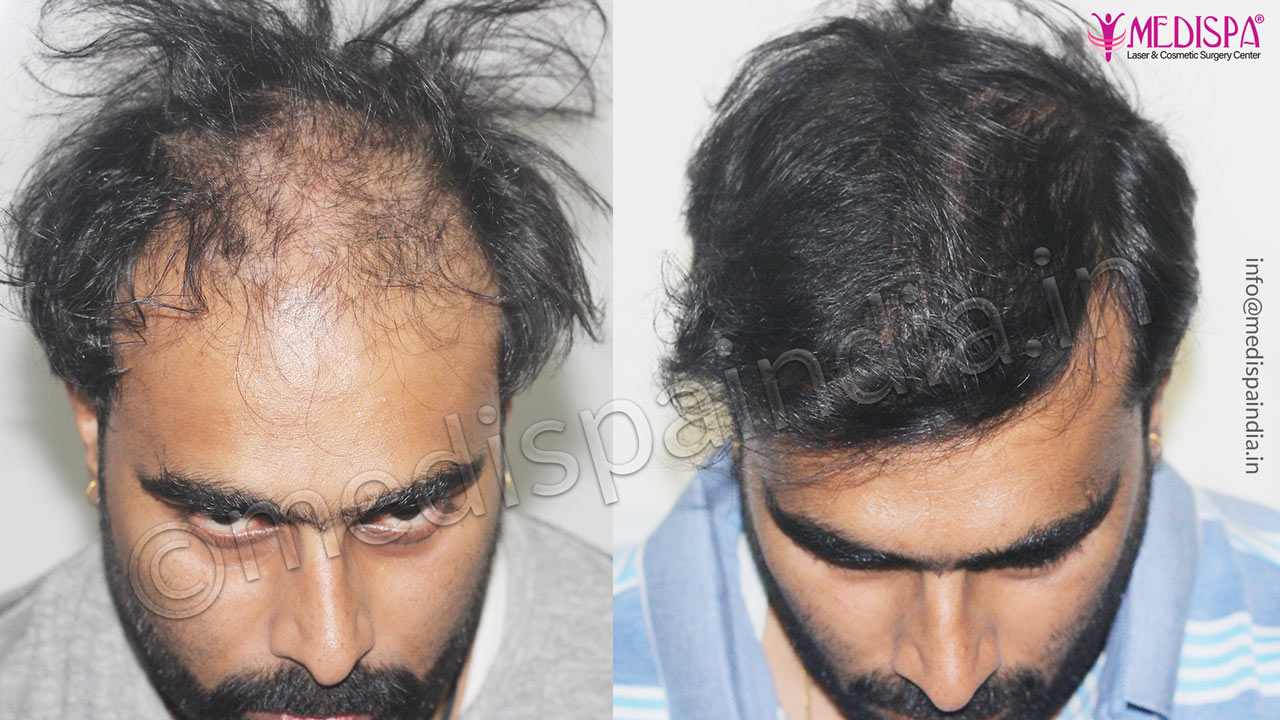 fue hair transplant delhi