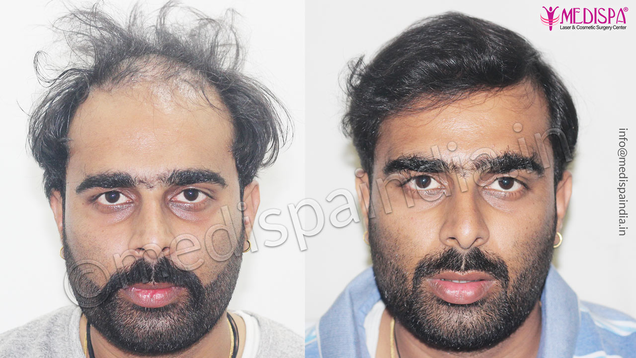 fue hair transplant jaipur