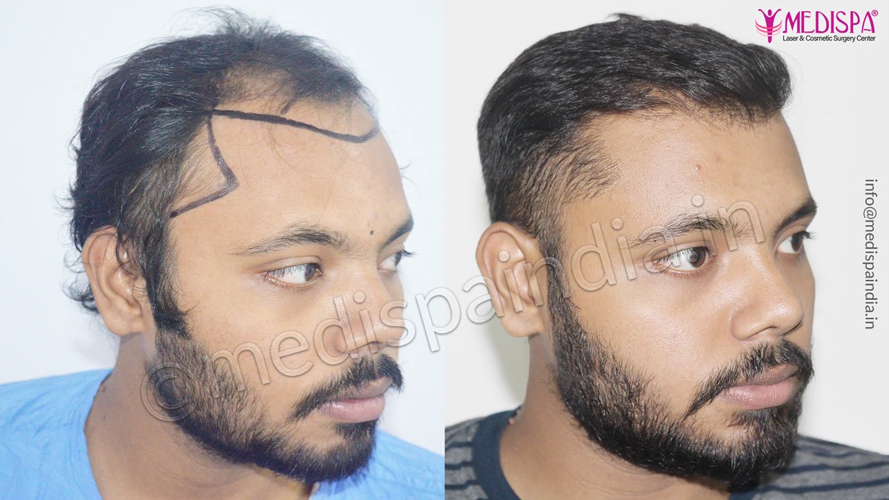 fue hair transplant