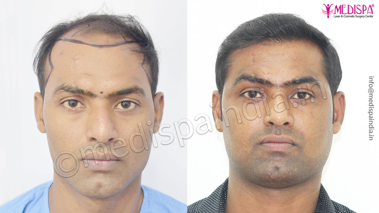 celebrity hair transplant india